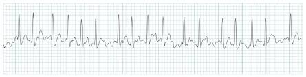 ECG rhythm strip example of atrial fibrillation