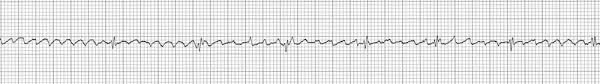 ECG rhythm strip example of atrial flutter