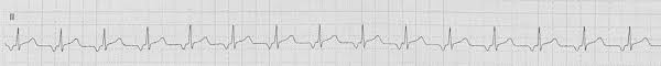 ECG rhythm strip example of atrial tachycardia