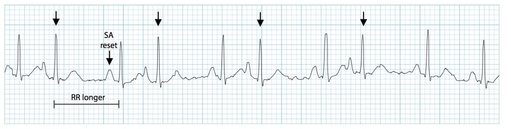 ECG rhythm strip example of a premature atrial contraction