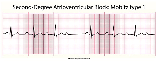 ECG rhythm strip example of second-degree AV block Mobitz I (Wenckebach)