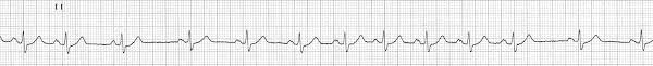 ECG rhythm strip example of sinus arrhythmia
