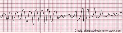 ECG rhythm strip example of torsades de pointes